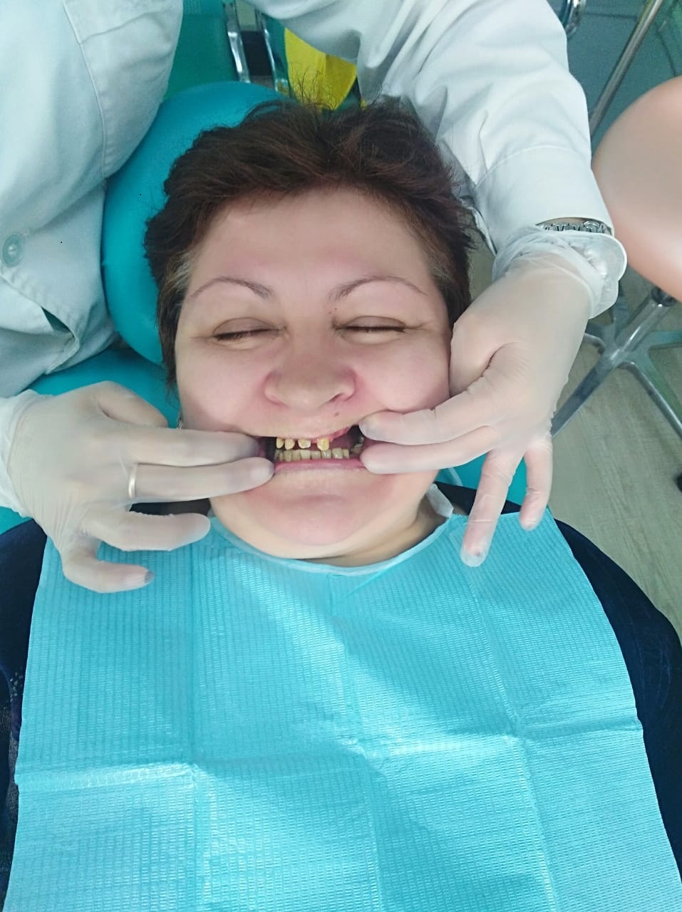 до и после протезирования зубов в Китае